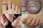Средства от запущенного грибка ногтей для эффективного лечения Избавиться от запущенного грибка