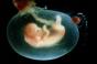 Rrjedhje ose këputje e hershme e lëngut amniotik