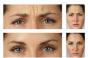 Vad betyder rynkor i ansiktet - vetenskapen om fysionomi Vad betyder vecken mellan ögonbrynen?